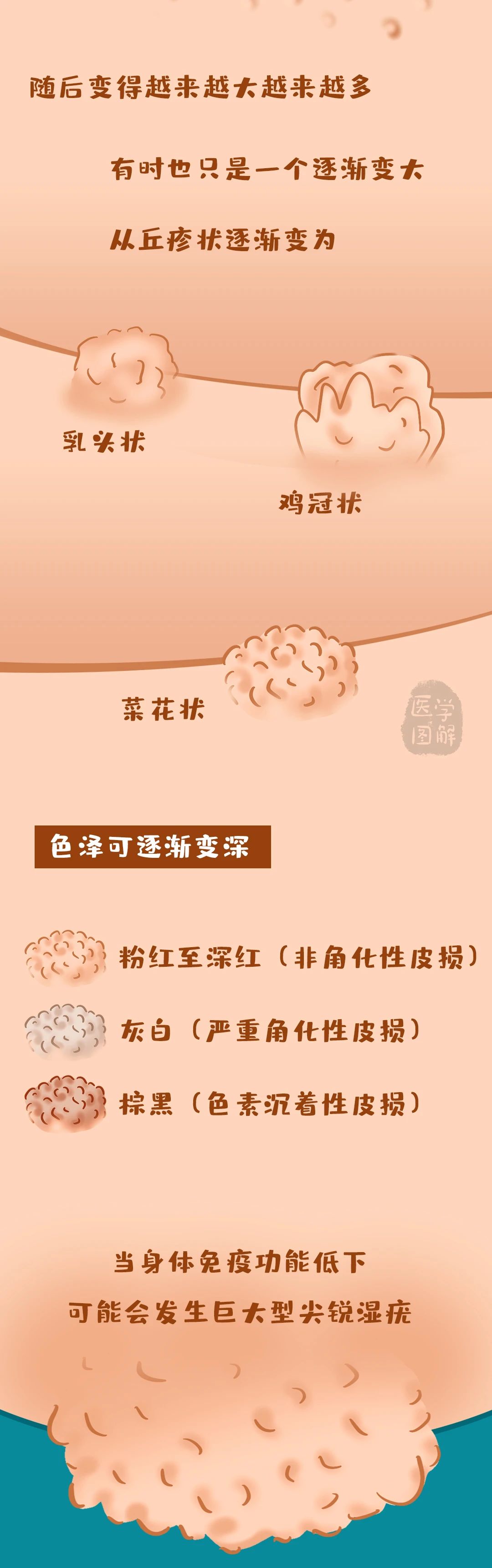 一朵盛开在皮肤上的菜花——尖锐湿疣