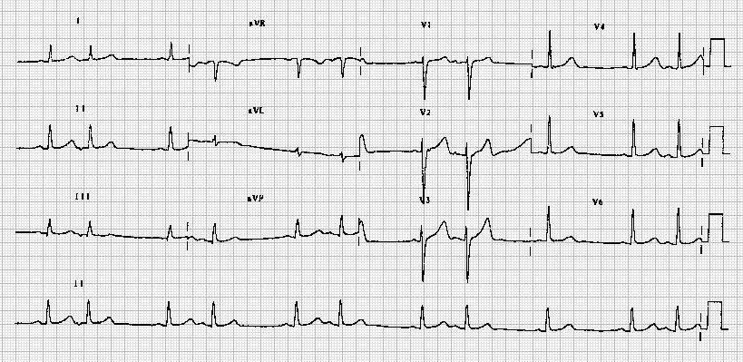 教你看心电图9——房性早搏二联律atrial bigeminy