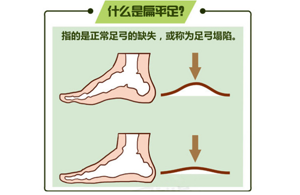 人的足弓高度是14mm-18mm,低于14mm的为扁平足,高于18mm的为高弓足