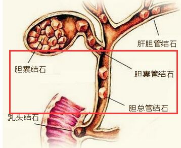8种人易生胆结石,快来看看有没有你