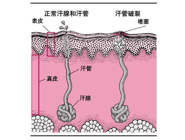 渔歌资讯 正文 2,白痱(晶形粟粒疹) 顾名思义,就是像水晶一样晶莹