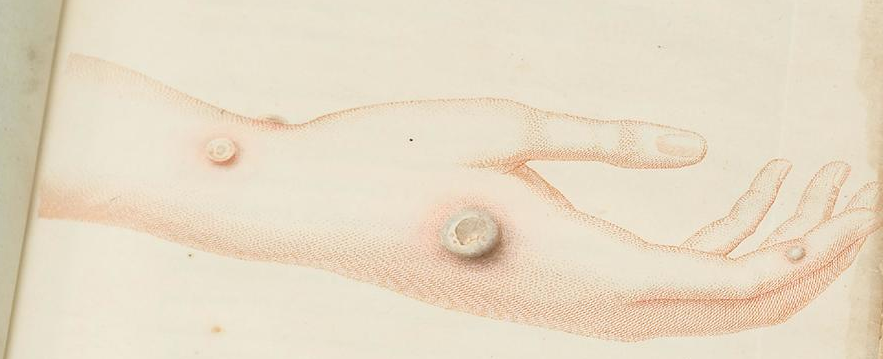 渔歌医疗|【疫苗趣闻】天花因“种痘”被彻底消灭