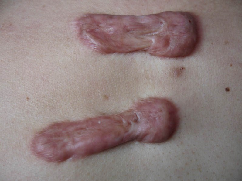 如何判断自己是不是疤痕体质?