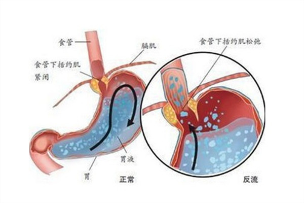 "烧心",烧的是心么?