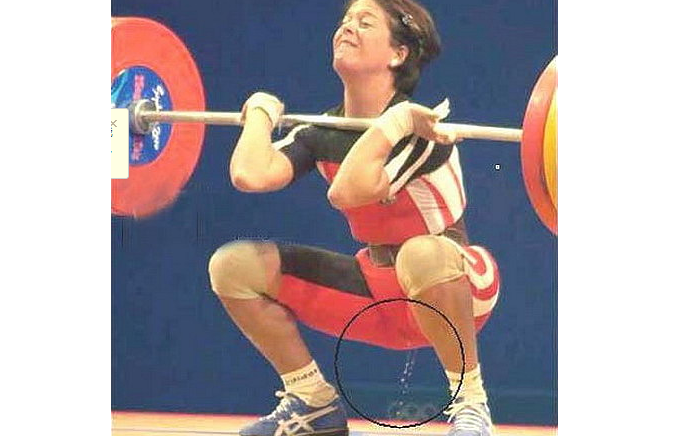 肾结石:活人真的能让尿憋死?